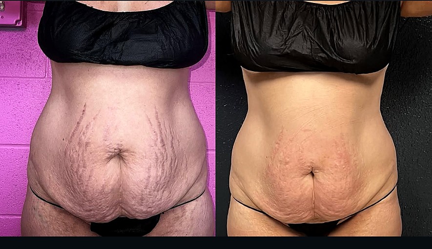 Before and after one Morpheus8 Body session for abdominal stretch marks at Grace MedSpa