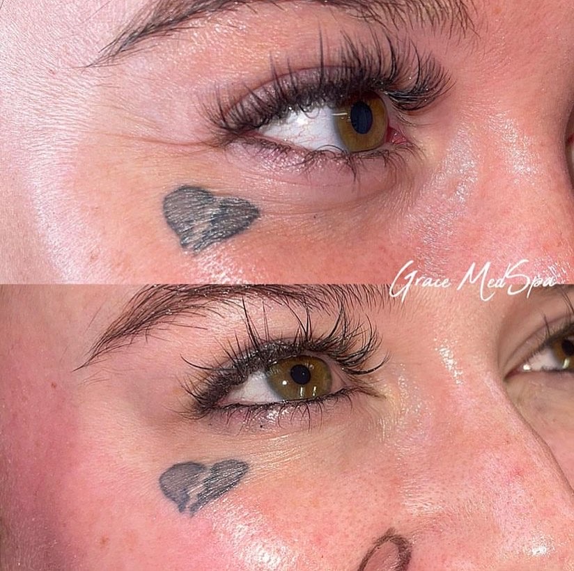 Real Grace patient before and after Botox for dynamic crow's-feet