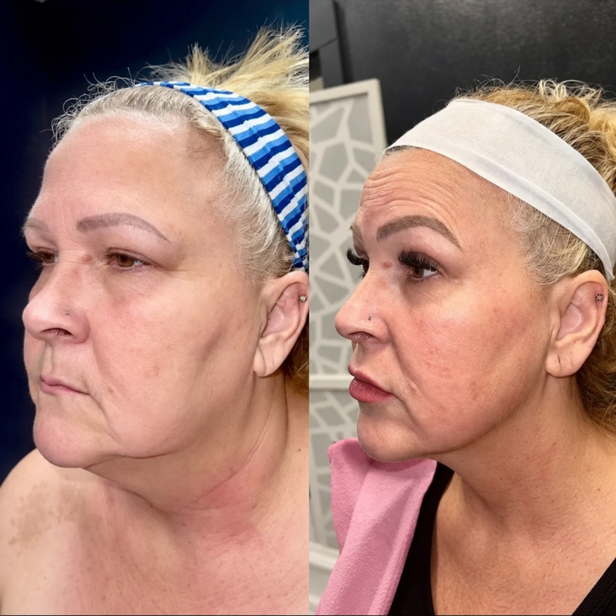 Grace MedSpa patient before and after approximately 50-pound GLP-1 weight loss with three Morpheus8 face and neck treatments and lip filler, left profile view.