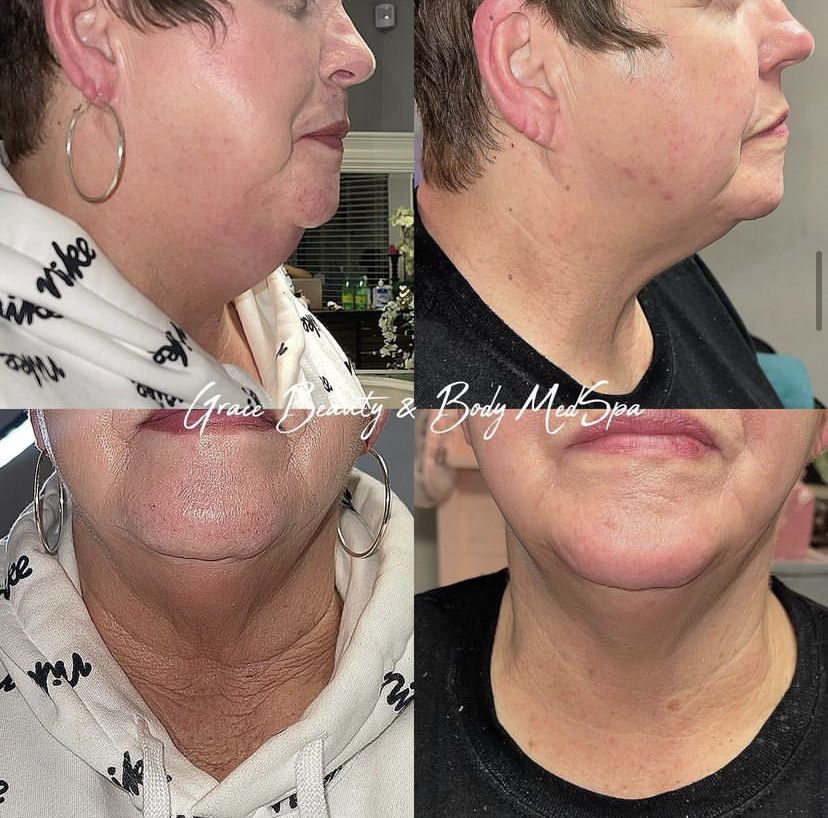 Grace MedSpa chin and neck fat-dissolving treatment result shown before and after