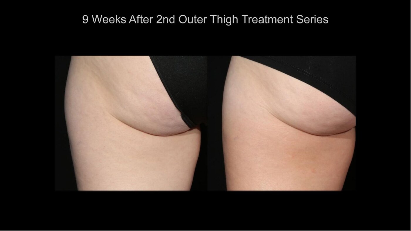 Manufacturer-supplied SculpSure before-and-after case showing the outer thigh 9 weeks after a second treatment series