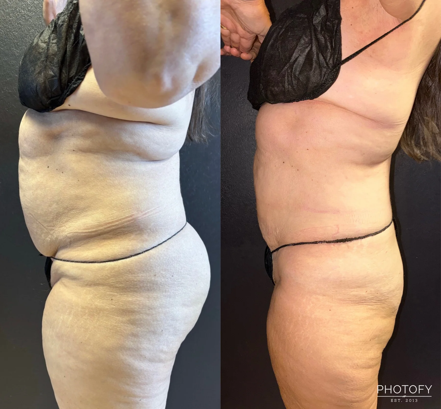 Grace MedSpa patient's abdomen before and after a body-transformation plan that included two SculpSure treatments.