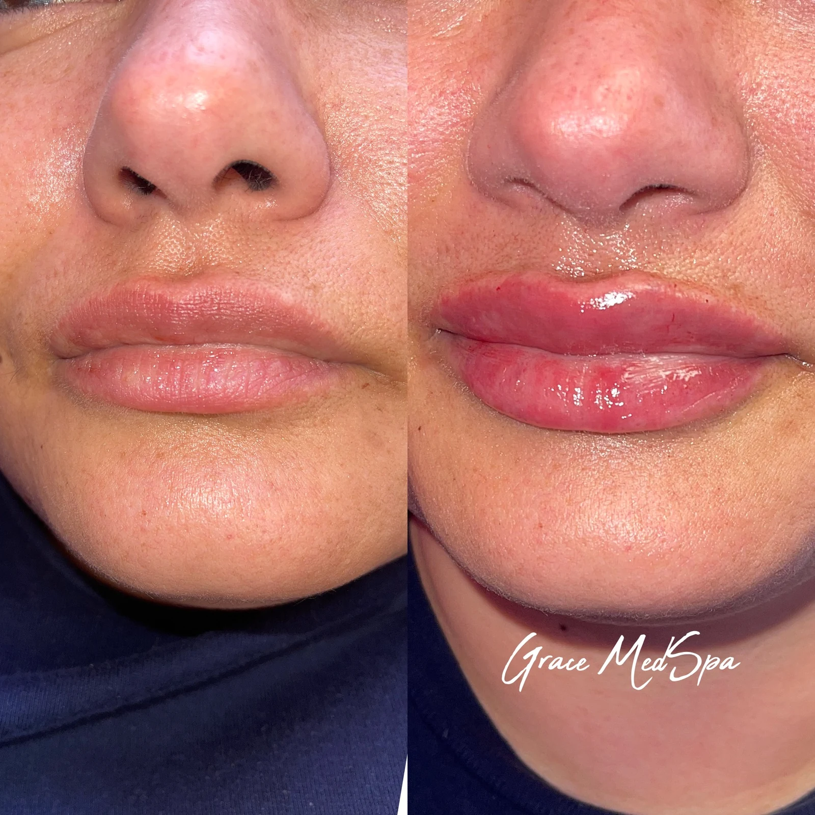 Real Grace patient before and after lip filler