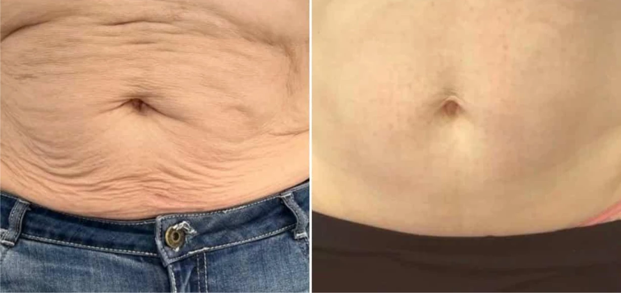 Manufacturer-supplied Morpheus8 before-and-after case showing upper abdominal skin laxity