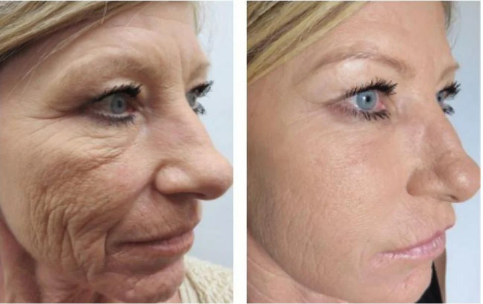Manufacturer-supplied Morpheus8 before-and-after case showing fine lines and wrinkles