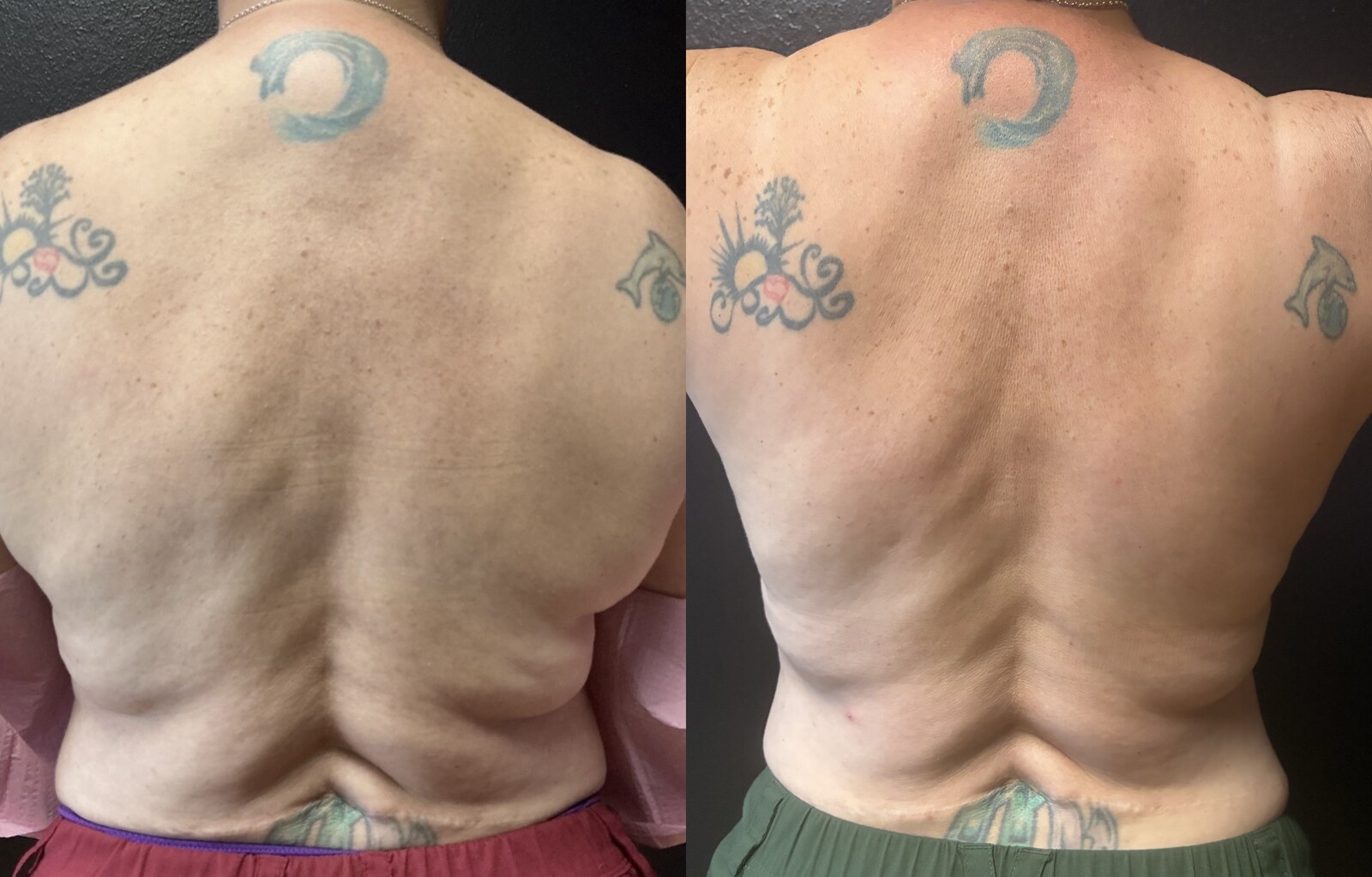 Before and after two rounds of SculpSure laser fat reduction across the back at Grace Med Spa in Austin