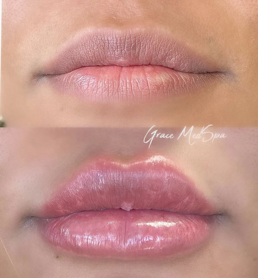 Front-facing lip filler before and after result from Grace MedSpa in Austin
