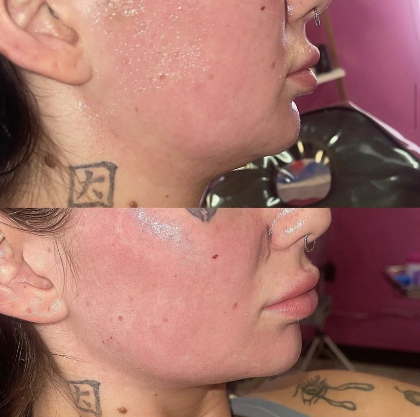 Real Grace patient before and after facial balancing with jawline definition