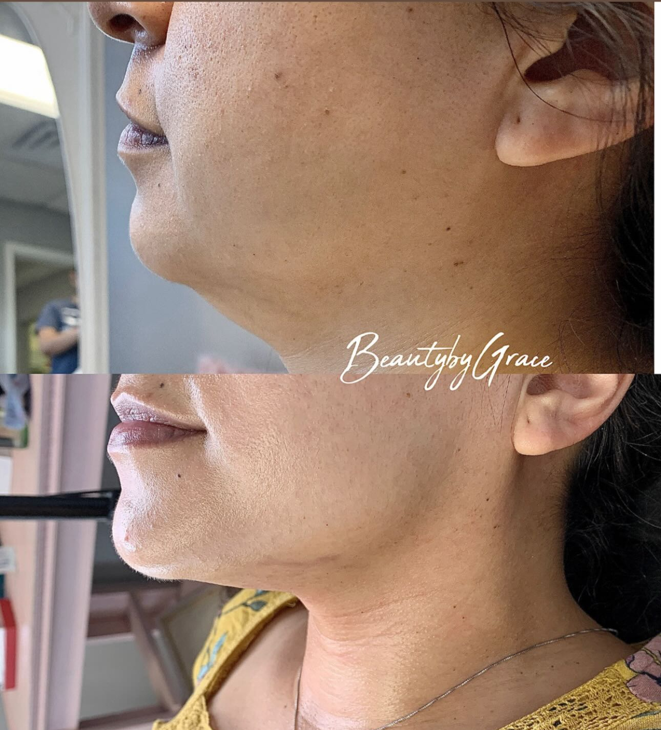 Actual Grace patient before-and-after comparison following fat-dissolving treatment and Morpheus8, case 1