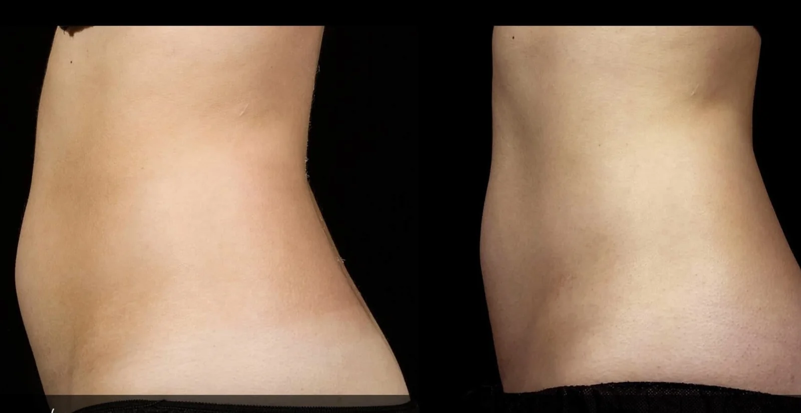 Side-view before and after photos of a Grace MedSpa SculpSure patient's abdomen after two rounds of SculpSure