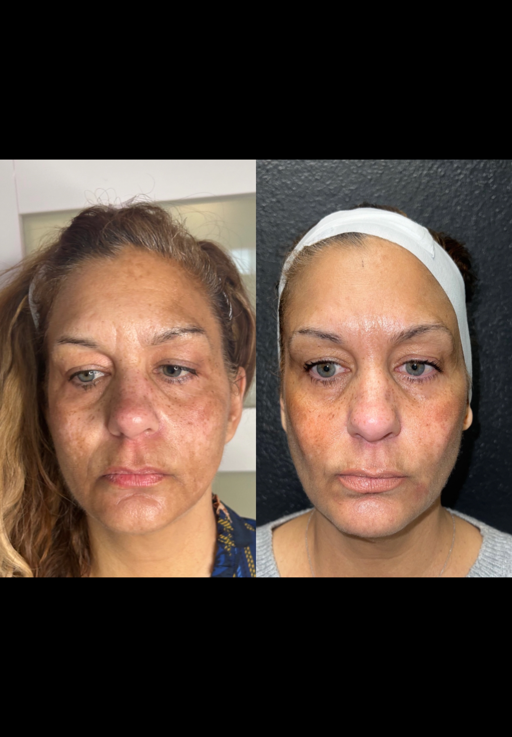 Grace MedSpa patient before and after pigment treatment following one treatment in Austin