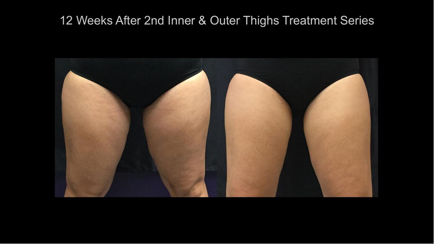 Manufacturer-supplied SculpSure before-and-after case showing the inner and outer thighs 12 weeks after a second treatment series
