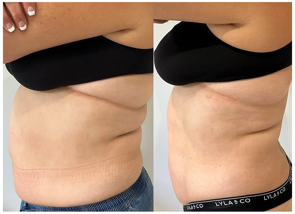 LIPOcel before-and-after side view of the abdomen