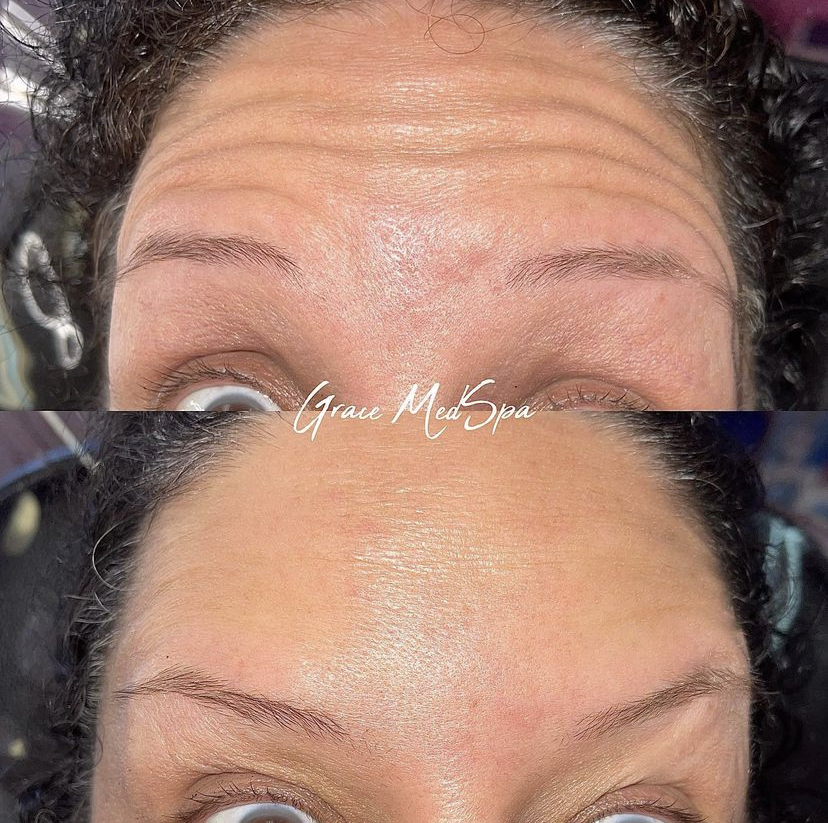 Real Grace patient before and after Botox treatment for forehead movement lines