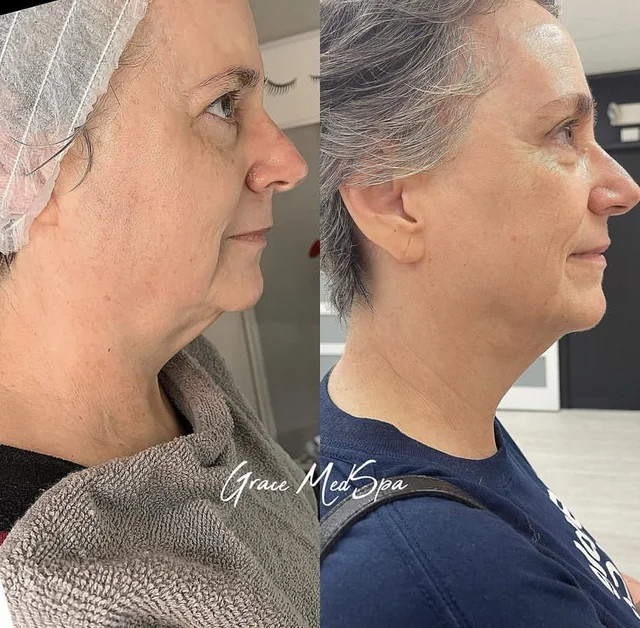 Forma facial tightening result preview
