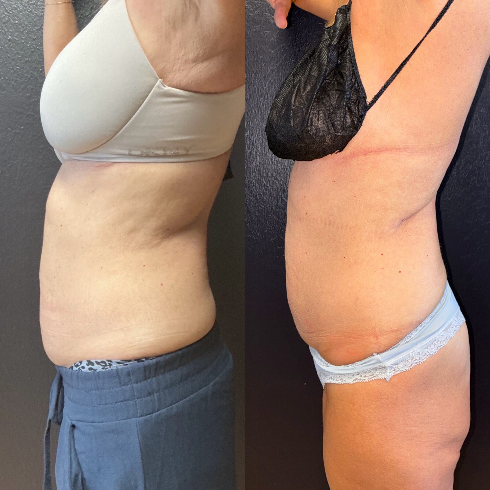 Before and after a combination plan of one round of SculpSure and four EvolveX sessions at Grace Med Spa in Austin