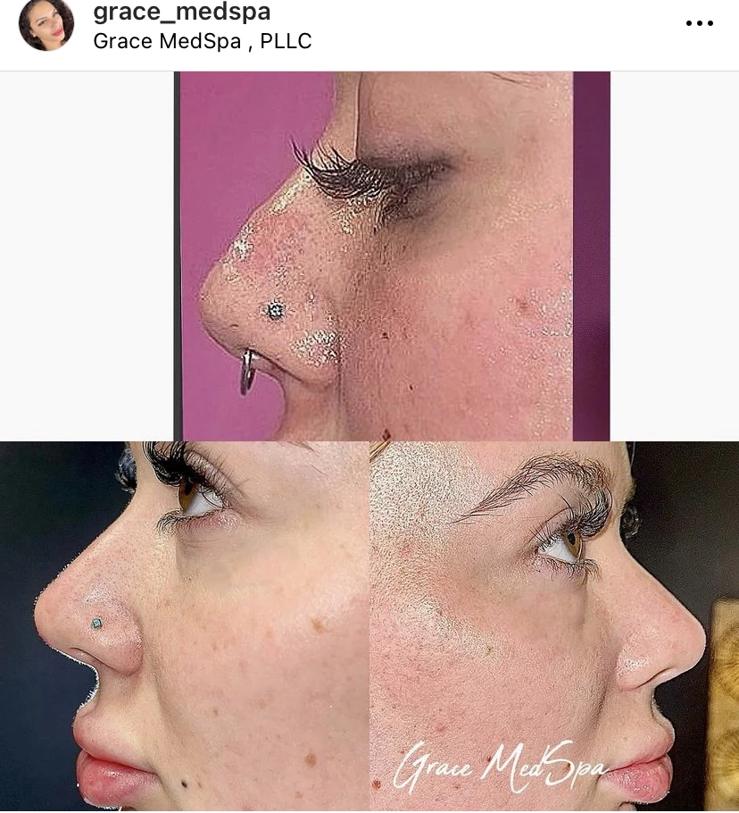 Real Grace patient before and after facial balancing shown in profile