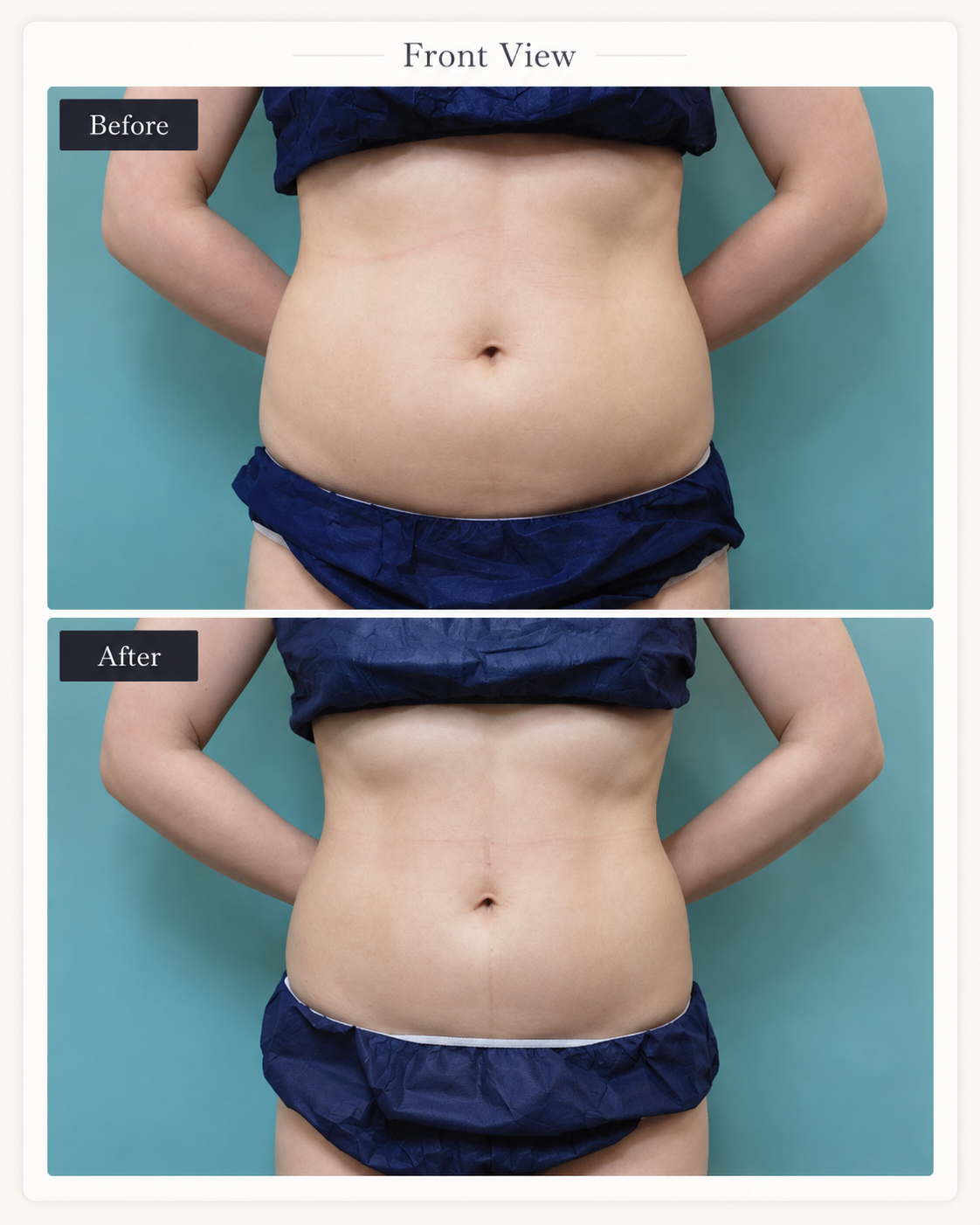 Front abdomen before and after LIPOcel treatment