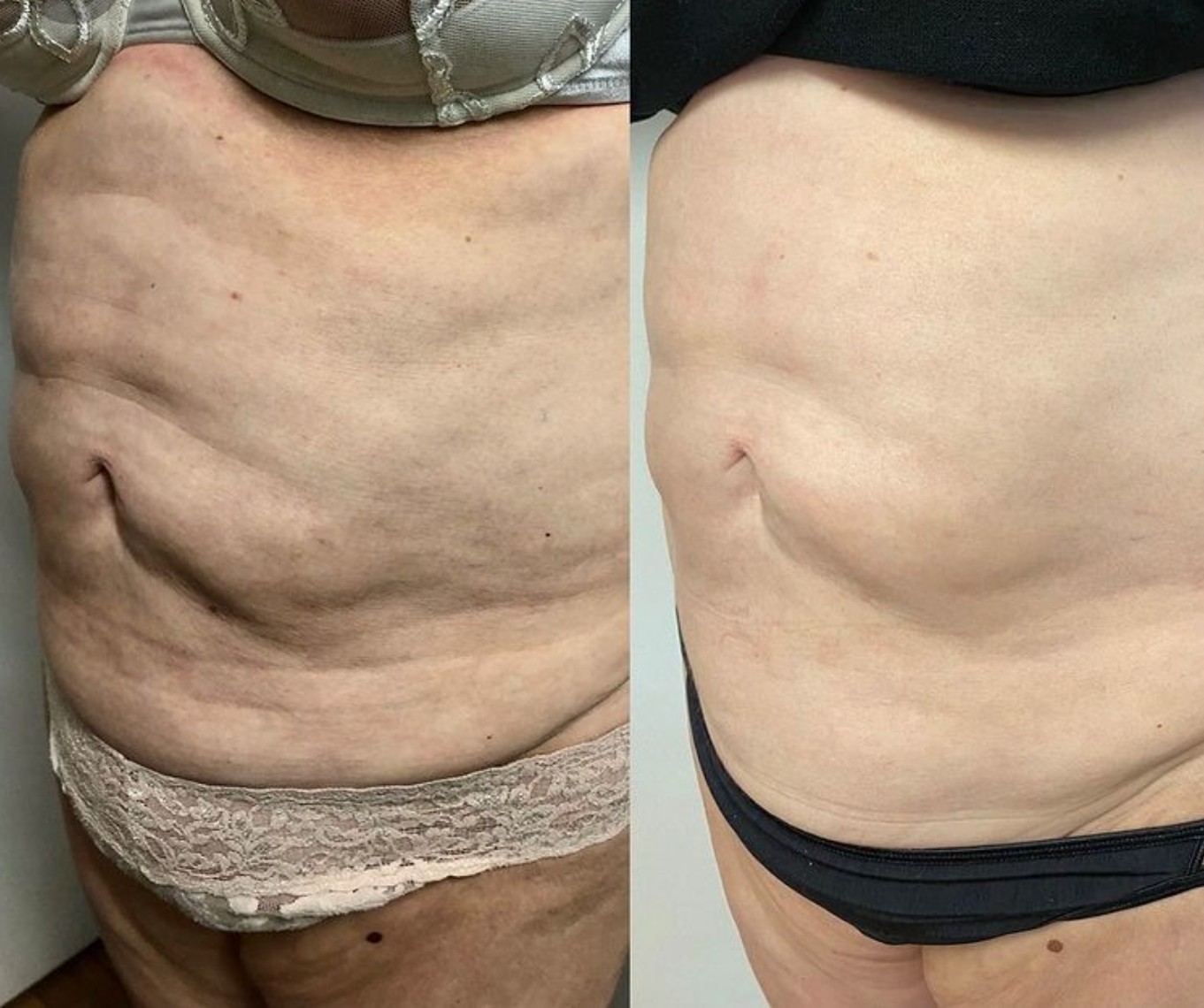 Before and after Morpheus8 Body RF microneedling of the abdomen at Grace MedSpa