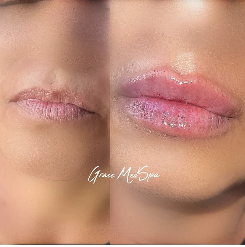 Lip filler before and after result showing proportion and contour at Grace MedSpa Austin