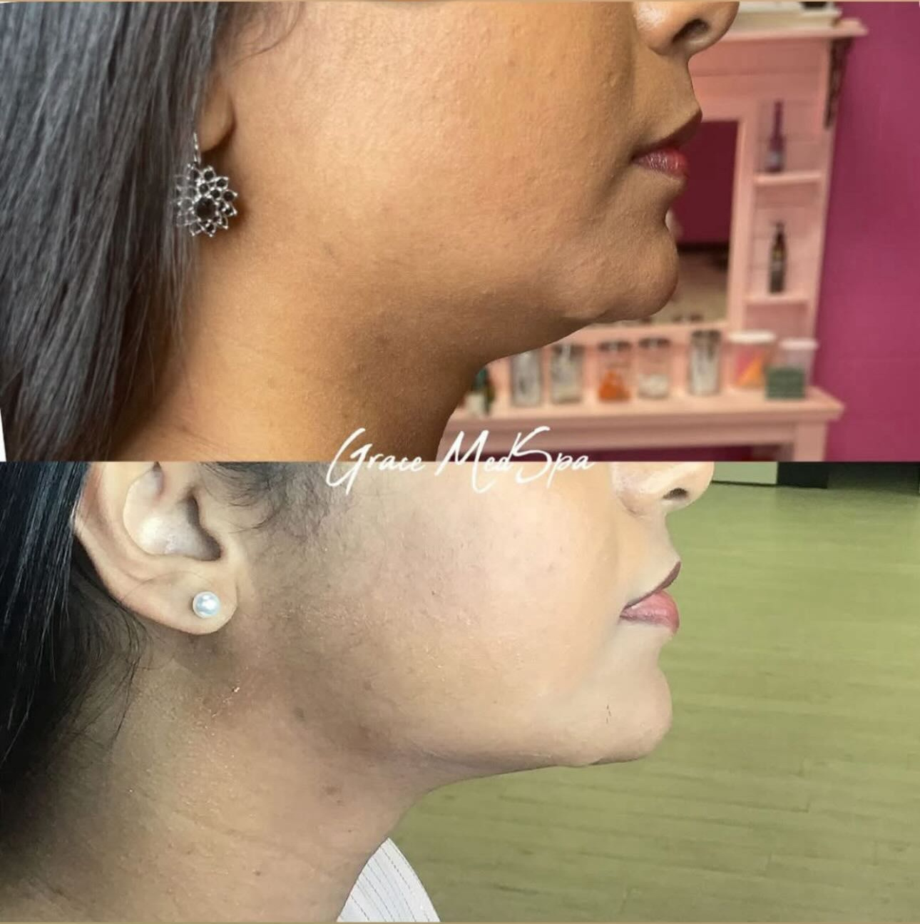 Actual Grace patient before-and-after comparison following fat-dissolving treatment and Morpheus8, case 2