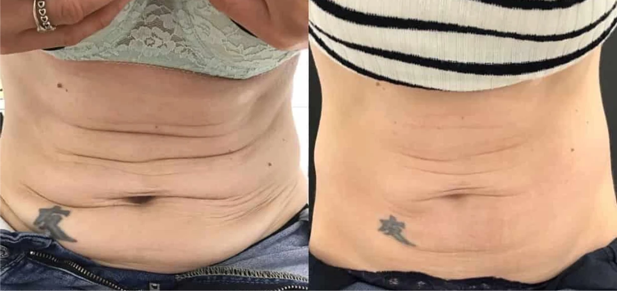 Manufacturer-supplied Morpheus8 before-and-after case showing lower abdominal skin laxity