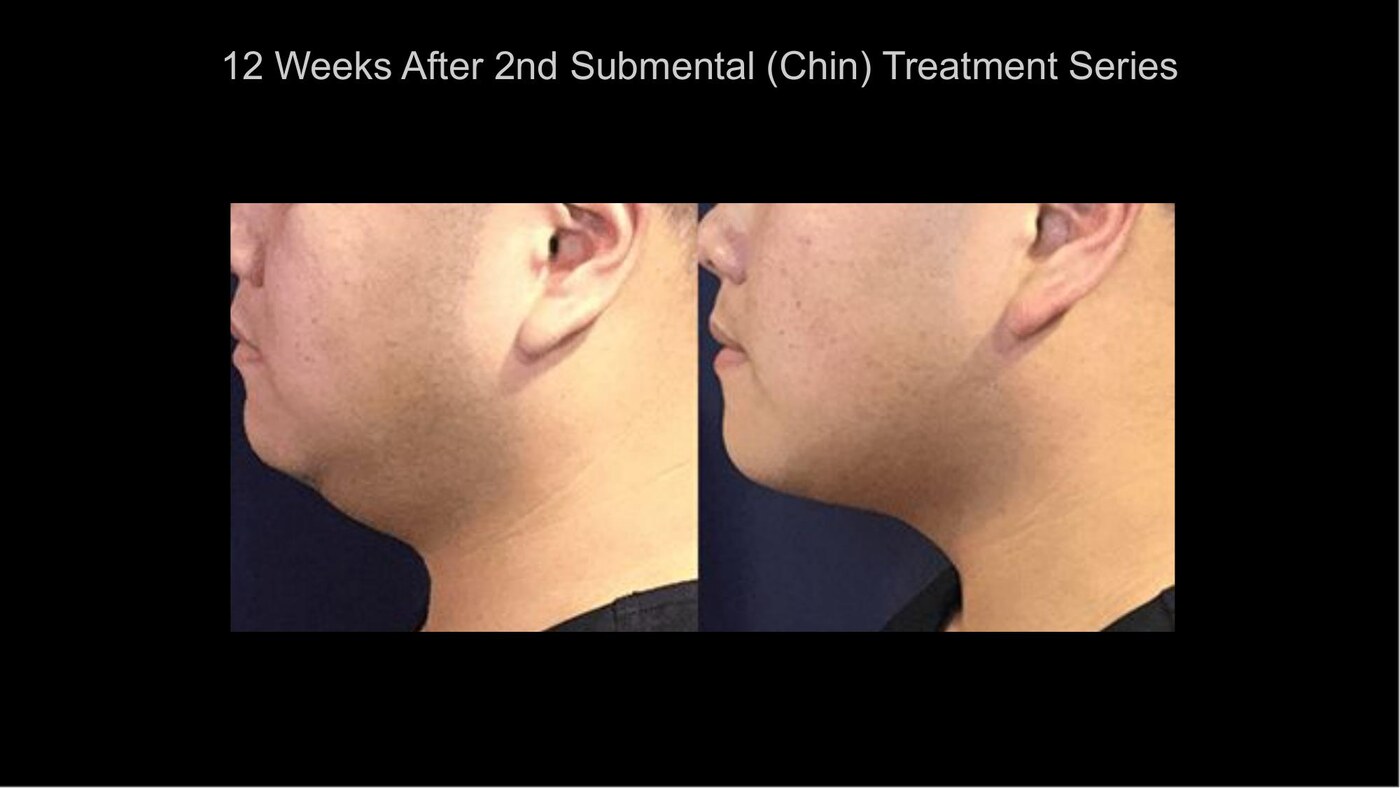 Manufacturer-supplied SculpSure before-and-after case showing the submental area 12 weeks after a second treatment series