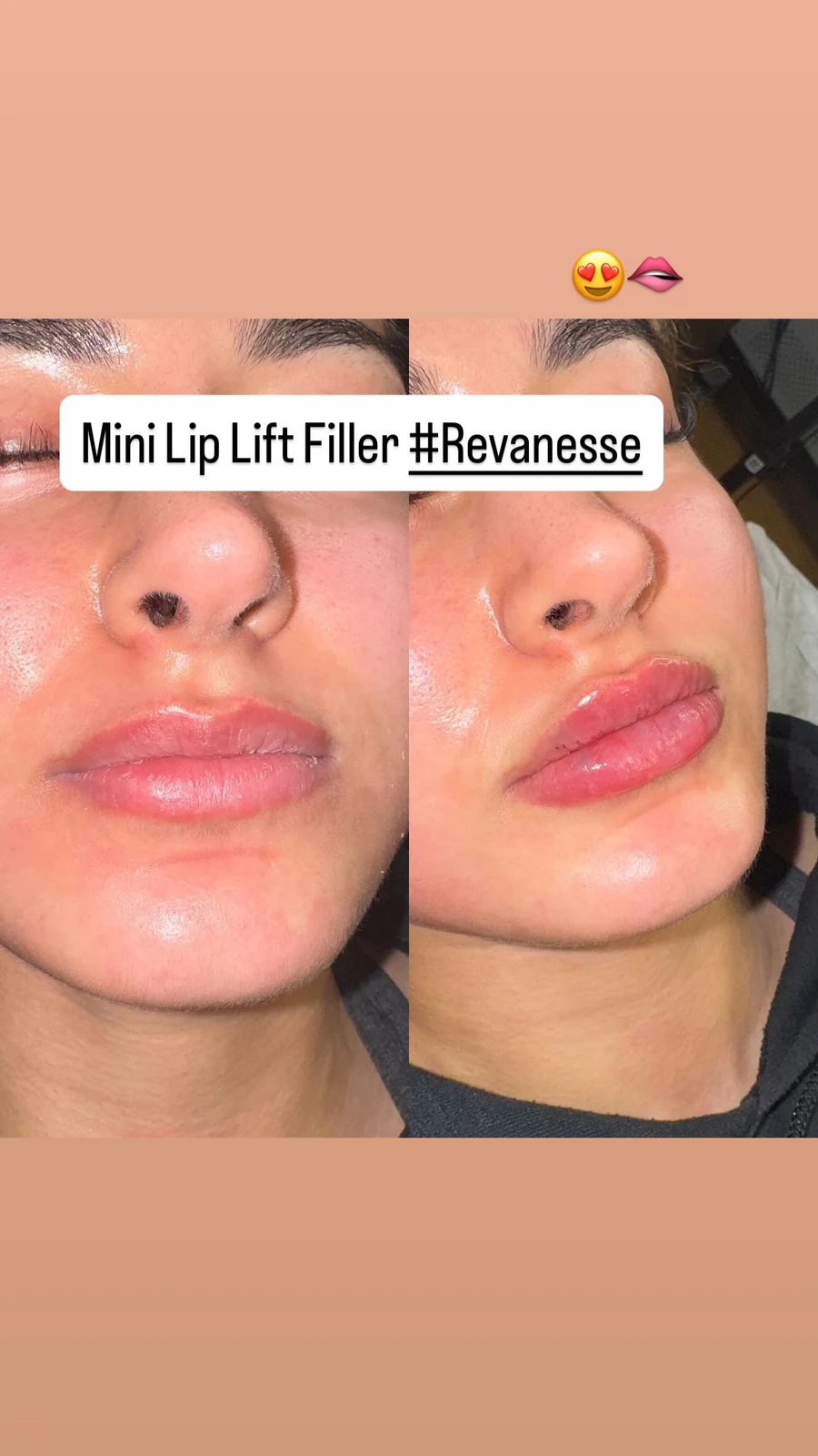 Documented Revanesse lip filler result from a real Grace MedSpa patient