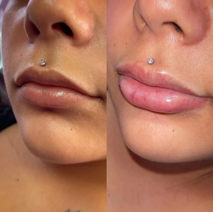 Side-view lip filler before and after result at Grace MedSpa Austin