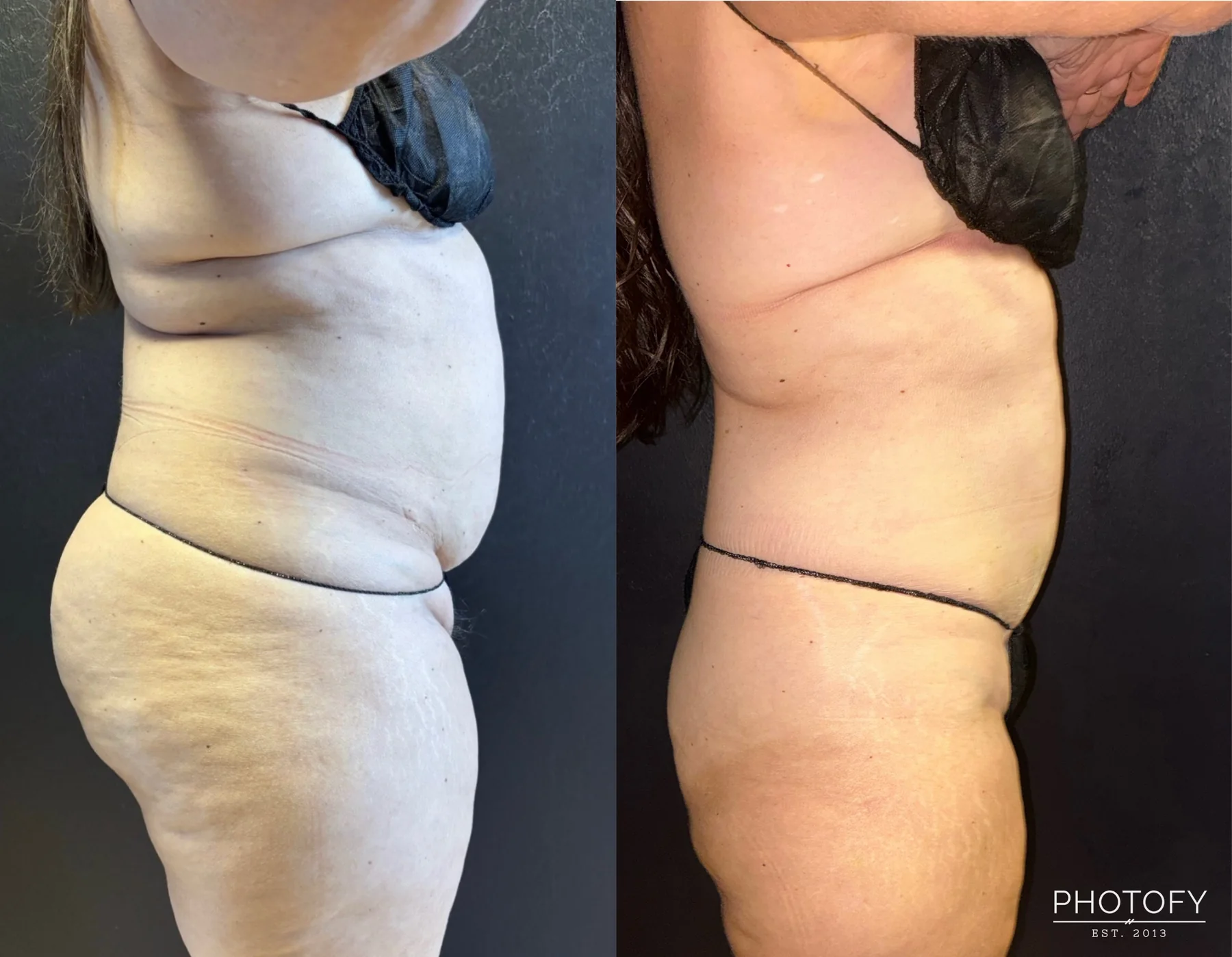 Grace MedSpa patient's abdomen before and after a body-transformation plan that included two SculpSure treatments.