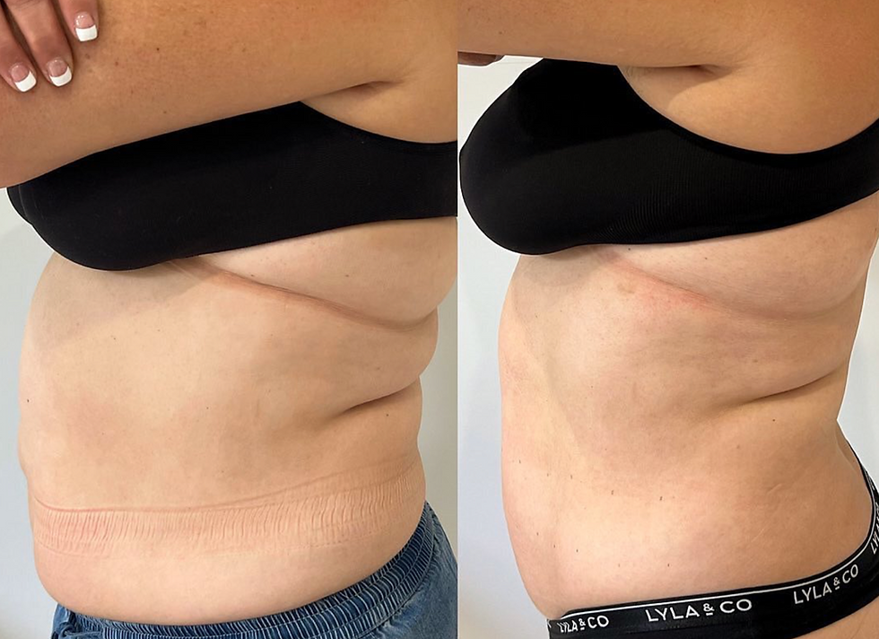 Representative before-and-after abdomen result following LIPOcel body contouring