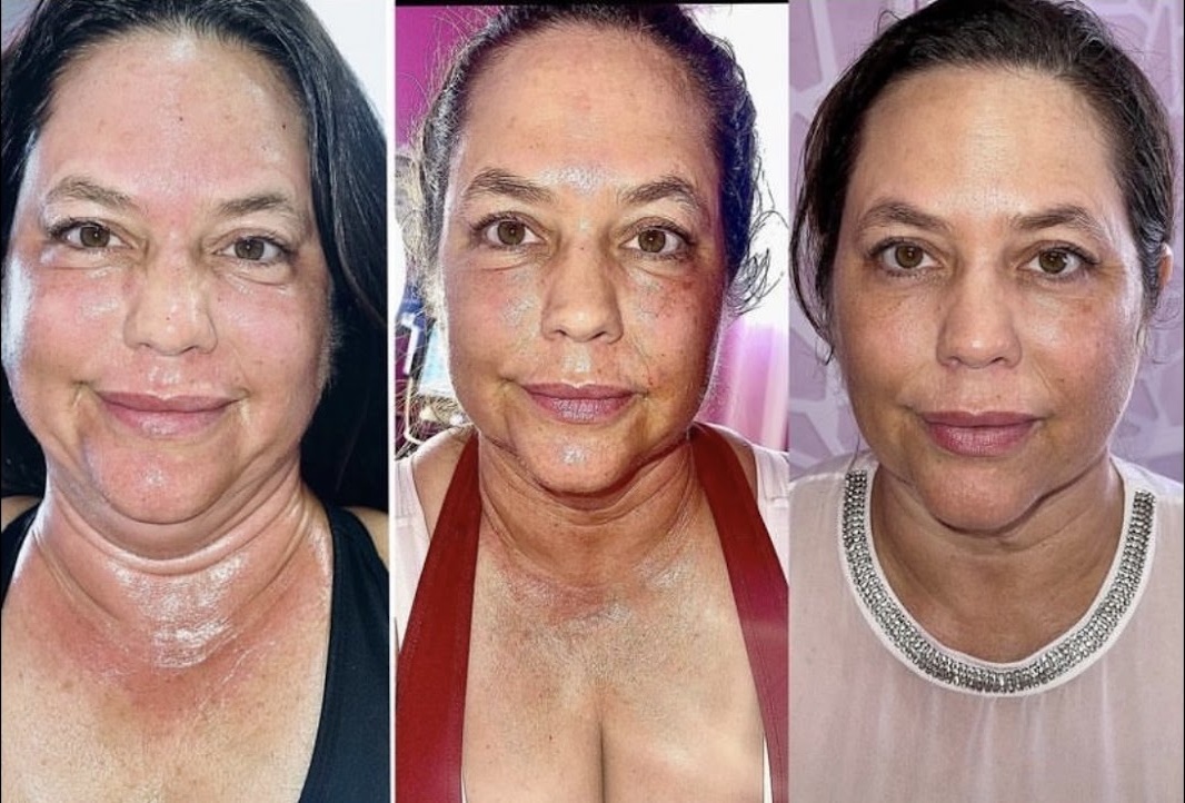 Before Morpheus8 Face treatment, after the first session and after the second session