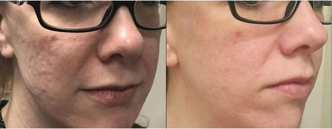 Manufacturer-supplied Morpheus8 before-and-after case showing acne scars and texture
