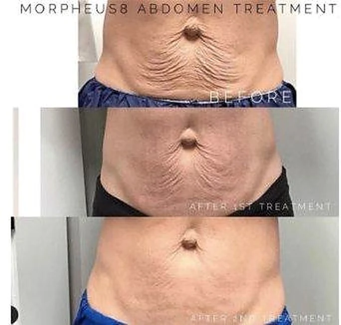 Grace patient three-stage abdominal Morpheus8 Body progression showing before, after the first treatment and after the second treatment