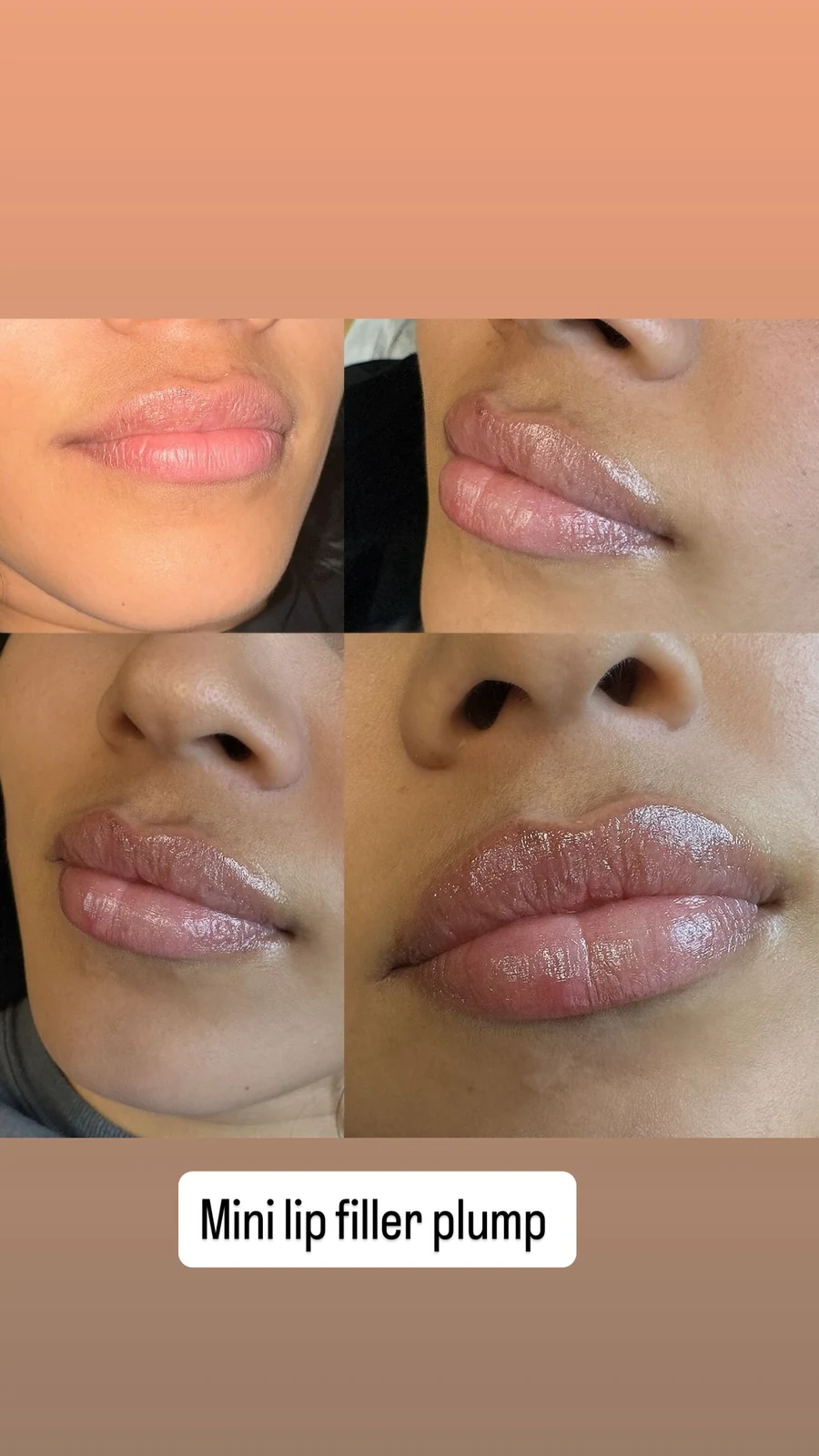 Subtle lip filler progression shown in a Grace MedSpa social story