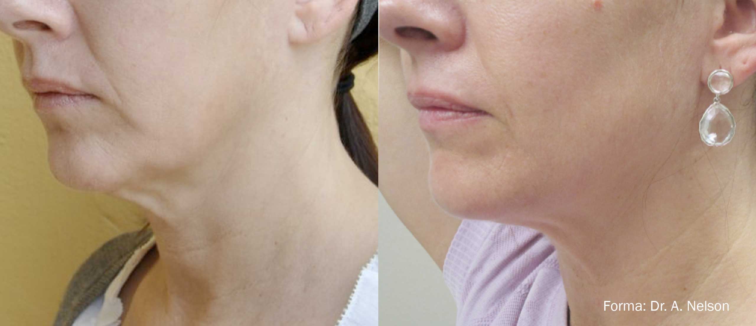 Forma before and after for neck skin tightening