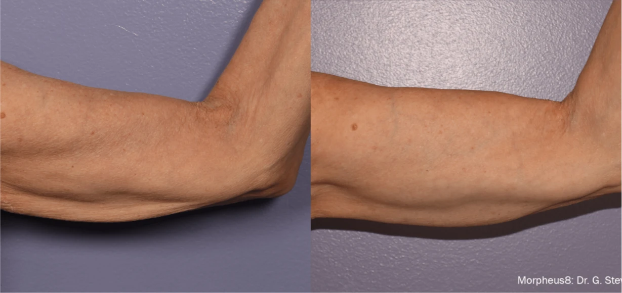 Manufacturer-supplied Morpheus8 before-and-after case showing upper-arm skin laxity