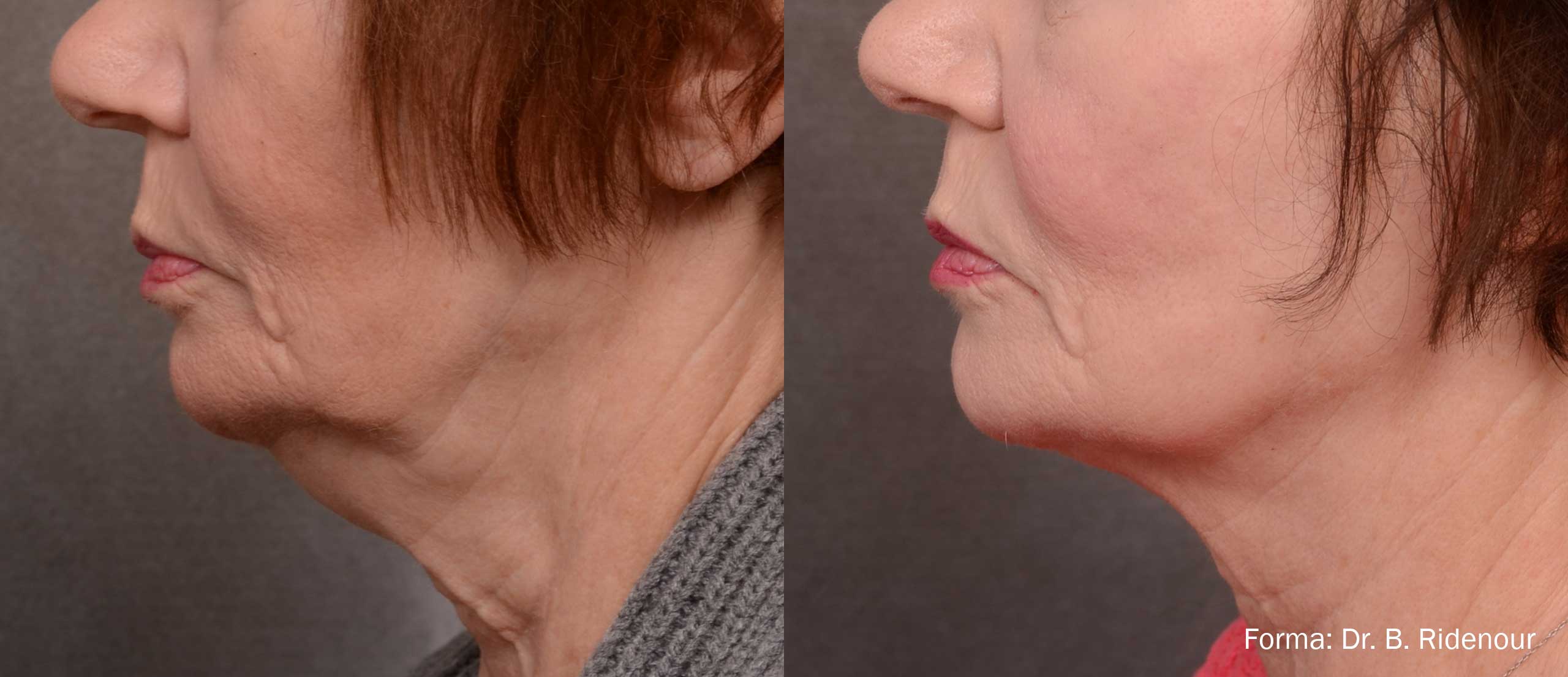 Forma before and after for jowls and lower face skin tightening