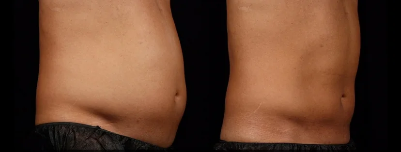 Before and after lower-abdomen photos of a Grace MedSpa SculpSure patient after two rounds of SculpSure