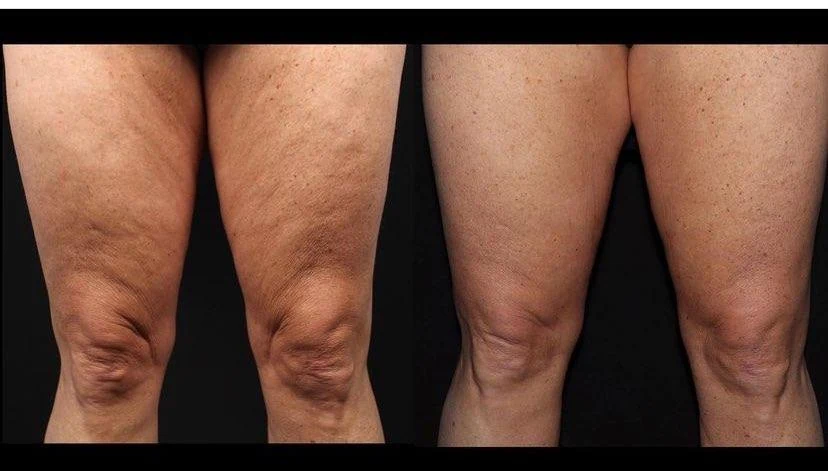 Grace patient knee and thigh before-and-after skin-tightening result following Morpheus8 Body