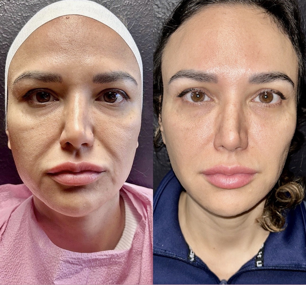 Before and after a combination plan of one Morpheus8 and three MultiFrax treatments at Grace Med Spa in Austin
