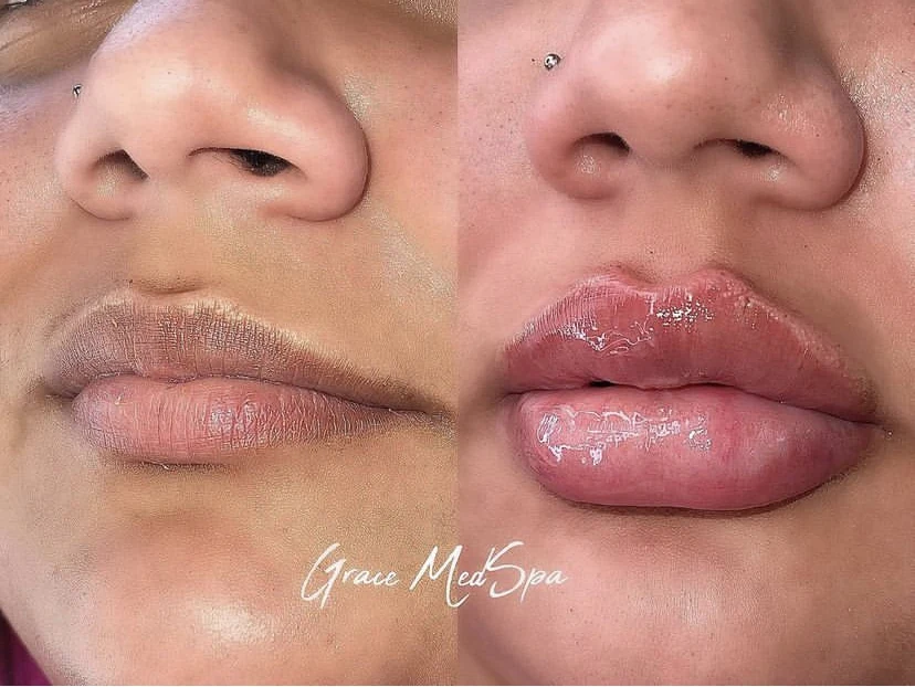 Real Grace patient before and after lip filler showing refined shape and proportion