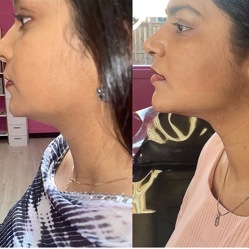 Grace MedSpa under-chin fat-dissolving treatment result in profile views