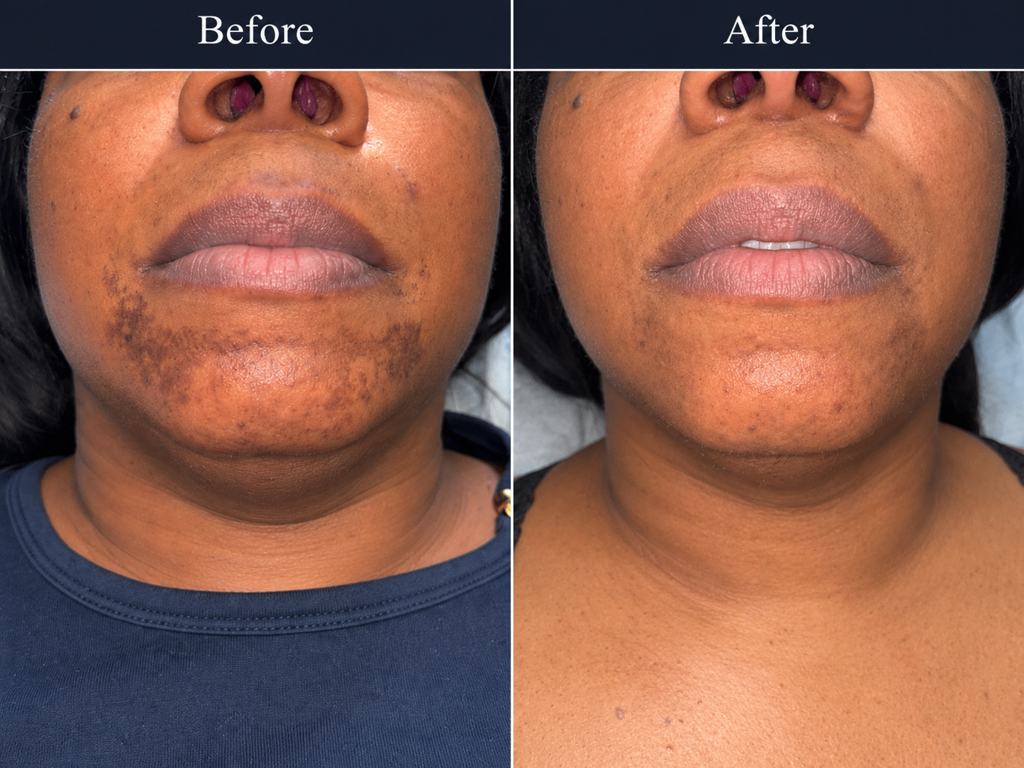 Before and after facial hyperpigmentation result showing improvement after 1 session at Grace MedSpa