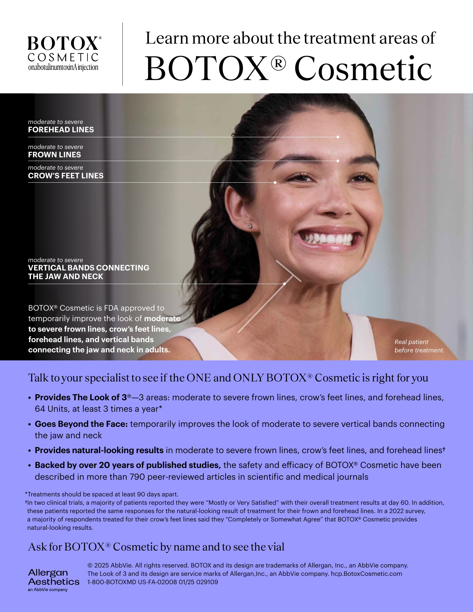 Allergan Aesthetics educational map of the four FDA-approved BOTOX Cosmetic treatment areas